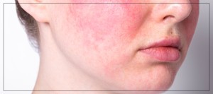 Mesobotox for Rosacea: A Soothing Solution for Sensitive Skin by Dr. Rios Mesobotox for Rosacea: A Soothing Solution for Sensitive Skin by Dr. Rios