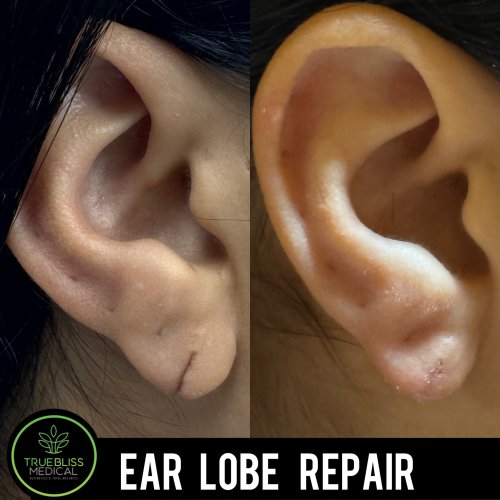 Earlobe Repair in Verona, NJ